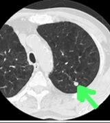 Image result for Lung Cancer On CT