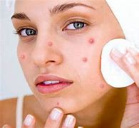 Image result for How to Prevent Pimples On Face