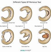 Image result for Meniscus Stress