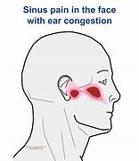 Image result for Sinus and Ear Pressure