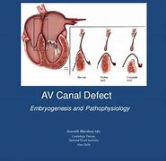 Image result for Unbalanced AV Canal