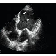 Image result for Sessile Thrombus