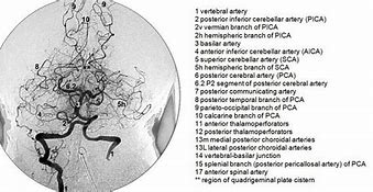 Image result for Brain MRI Angiogram