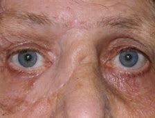 Image result for Medial Canthus Bilobed Flap