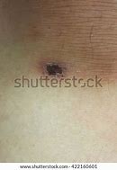 Image result for Knee Scab