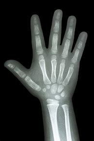 Image result for X-ray of Baby Hand