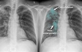 Image result for Chest X-ray of TB