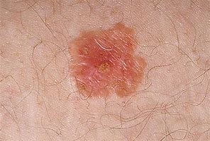 Image result for Age Spots Skin Cancer