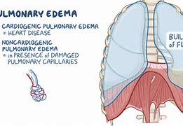 Image result for Acute Pulmonary Oedema Positioning