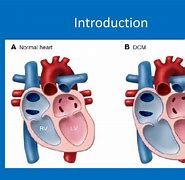 Image result for Dilated Cardiomyopathy EKG