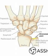 Image result for Pins in Wrist Pain