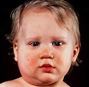 Image result for Mumps Child