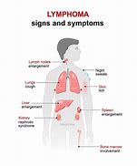 Image result for Hodgkin Lymphoma Cancer Symptoms