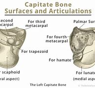 Image result for Capitate Bone Enlarged