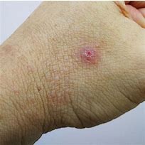 Image result for What Are Pustules On the Skin