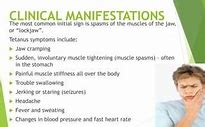 Image result for Tetanus Spasm