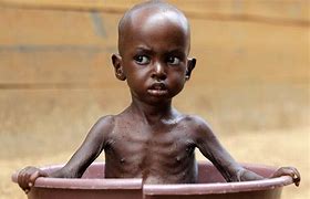 Image result for Starving Ethiopian Child