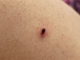 Image result for Tick Buried Under Skin