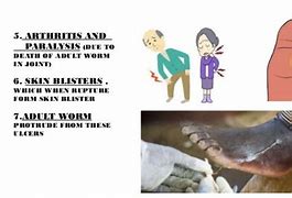 Image result for Dracunculiasis Treatment