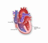 Image result for Complete Atrioventricular Canal Defect