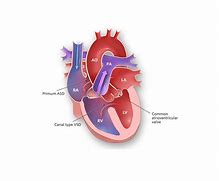 Image result for Atrioventricular Canal Defect Osmosis