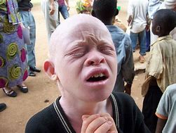 Image result for South African Albino