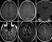 Image result for Abnormal Brain MRI without Contrast