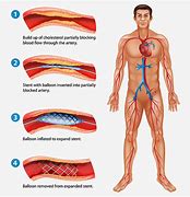 Image result for Angio Vue Choriocapillaris