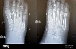 Image result for Thumb X-ray Child