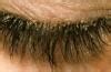 Image result for Treatment for Eyelash Mites