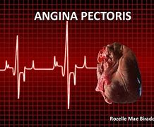 Image result for Angina Pectoris Anatomical Position