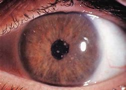 Image result for Uveitis Vision