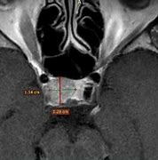 Image result for T1 MRI Head