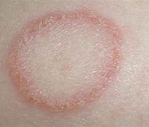 Image result for Small Red Circular Rash On Skin