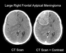 Image result for Meningioma CT Head