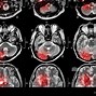 Image result for Abnormal Brain MRI without Contrast