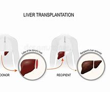 Image result for Liver Transplant Clip Art