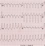 Image result for Right Ventricular Outflow Tract