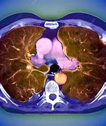 Image result for Emphysema