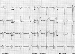 Image result for Right Ventricular Hypertrophy Echo