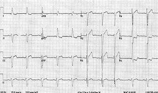 Image result for Right Ventricular Hypertrophy