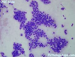 Image result for Adrenal Cytology