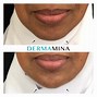 Image result for Chin Correction Filler