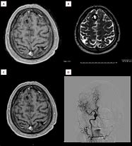 Image result for T1 MRI Head