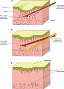 Image result for Subclinical Acne