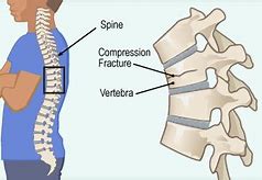 Image result for Compression Fracture Lumbar Surgery