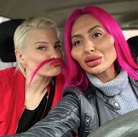 Image result for Worst Lip Fillers