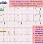 Image result for Pericarditis EKG Findings Example