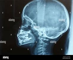 Image result for Thumb X-ray Child