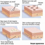 Image result for Herpes Genitalis